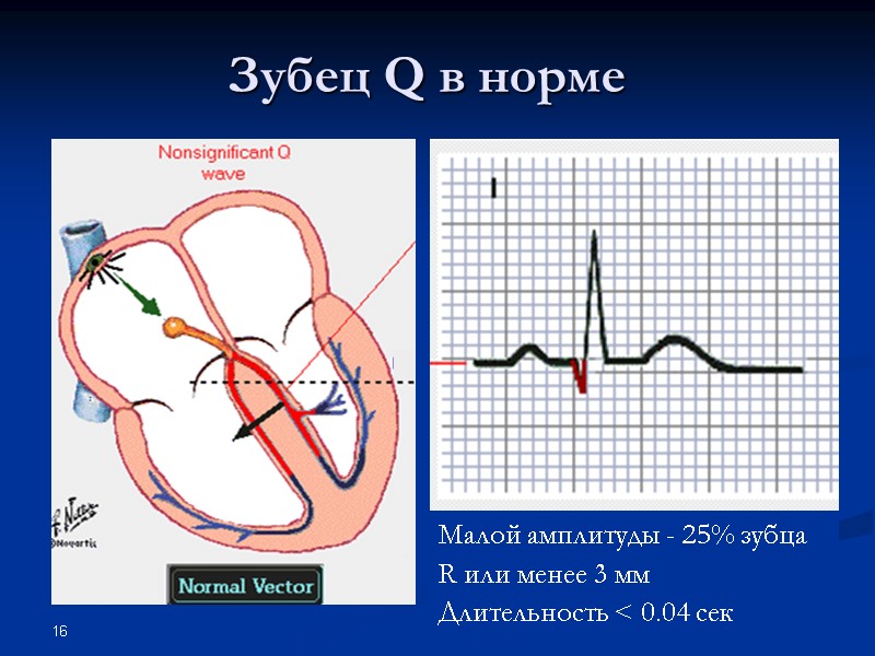16 Зубец Q в норме Малой амплитуды - 25% зубца R или менее 3